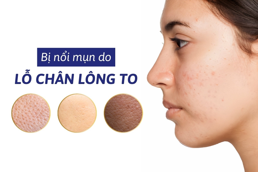 Những người có lỗ chân lông to thường dễ bị mụn