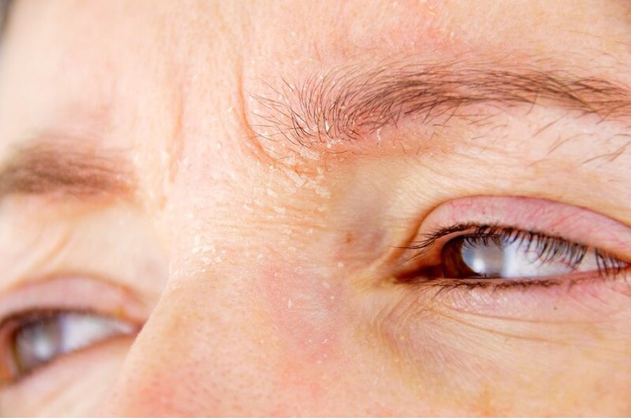 Lông mày xoáy là hiện tượng đuôi lông mày có hình xoắn ốc Lông mày xoáy là hiện tượng đuôi lông mày có hình xoắn ốc