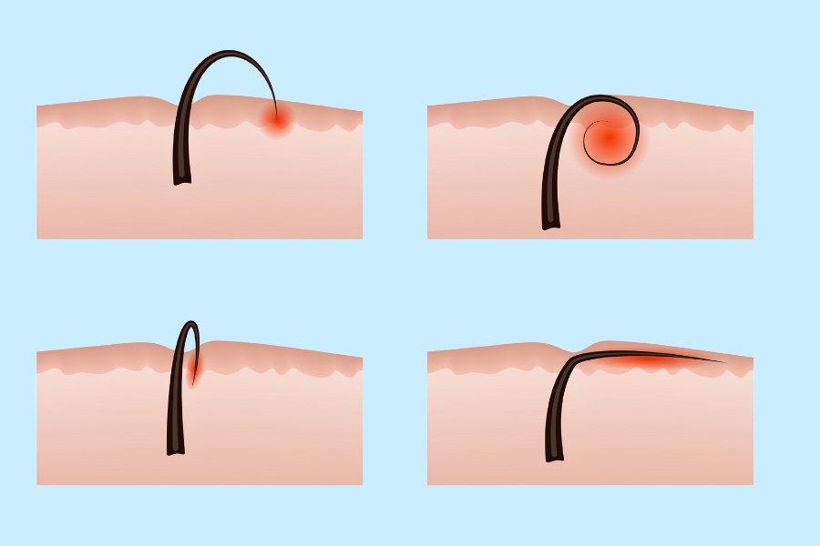 Lông mọc ngược thường cuộn tròn lại và nằm dưới bề mặt da Lông mọc ngược thường cuộn tròn lại và nằm dưới bề mặt da