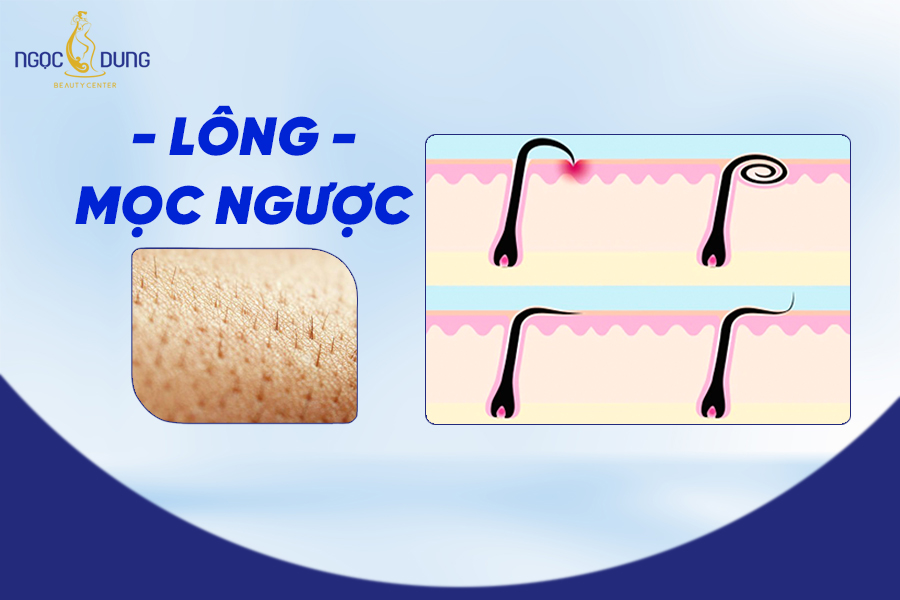 Lông mọc ngược