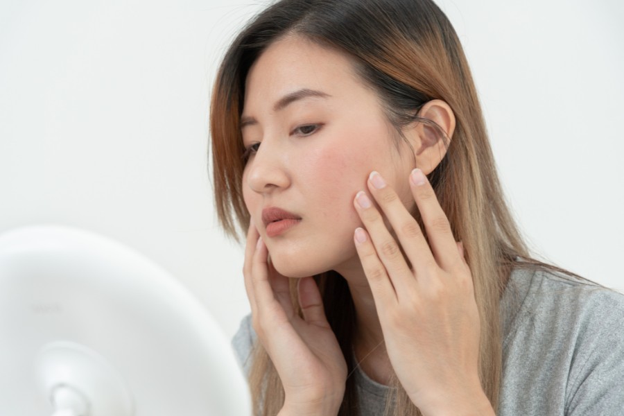 mat na khoai tay tri tham mun