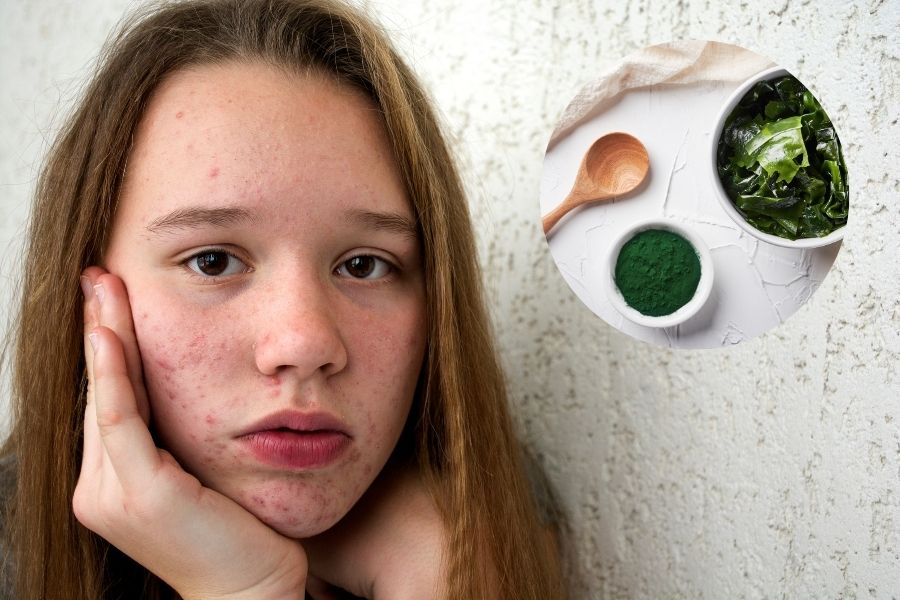 Mặt nạ tảo biển có khả năng chống viêm và hỗ trợ điều trị mụn hiệu quả