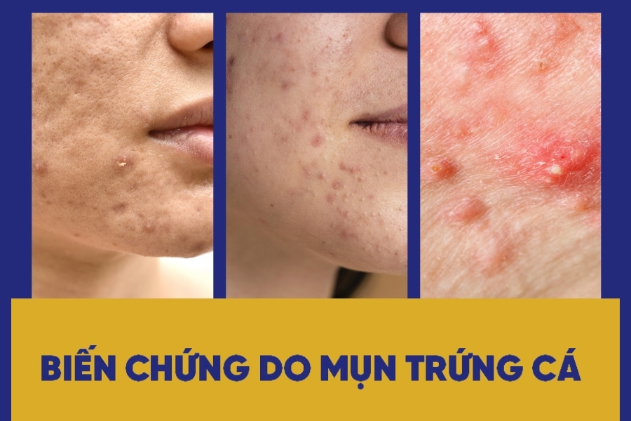 Các biến chứng để lại của mụn trứng cá Các biến chứng để lại của mụn trứng cá