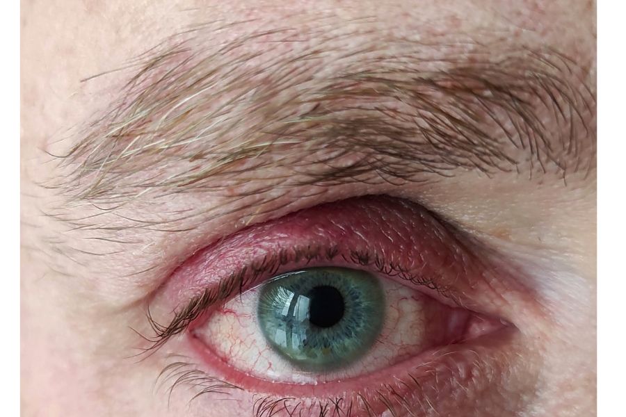 Người trong mắt chứa tia máu, lông mày chổi xể thường là dấu hiệu của “hung quang” Người trong mắt chứa tia máu, lông mày chổi xể thường là dấu hiệu của “hung quang”