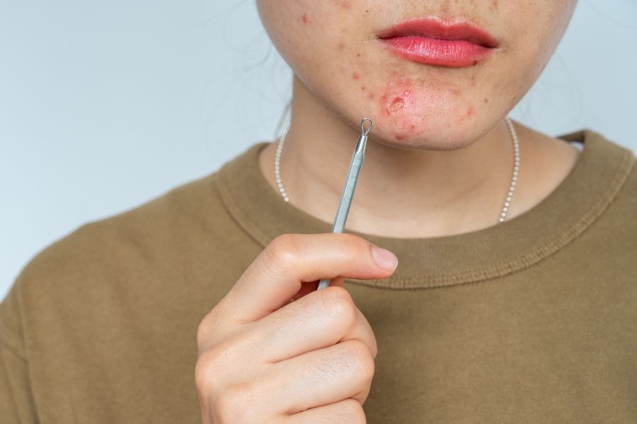 Mụn bọc không nặn có tự hết không? Theo chuyên gia mụn bọc không thể biến mất nếu không được can thiệp
