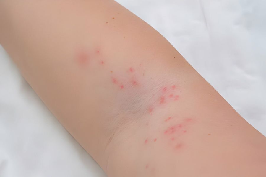 Tăng tiết bã nhờn quá mức khiến bắp tay nổi mụn