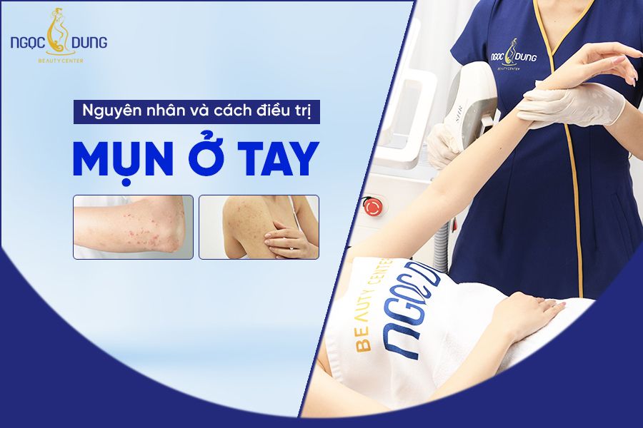 Mụn ở tay hình thành do những nguyên nhân nào? Bật mí cách trị nổi mụn ở bắp tay đúng cách