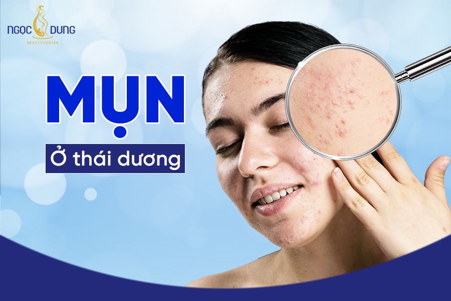 Mụn ở thái dương xuất hiện do những nguyên nhân nào? Đâu là cách khắc phục