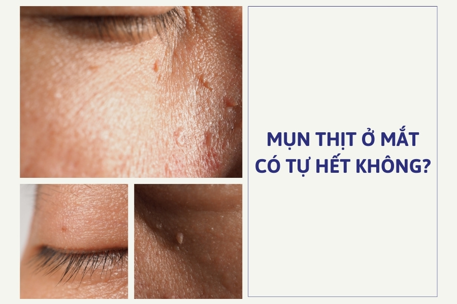 Mụn thịt trên mí mắt không thể tự hết Mụn thịt trên mí mắt không thể tự hết