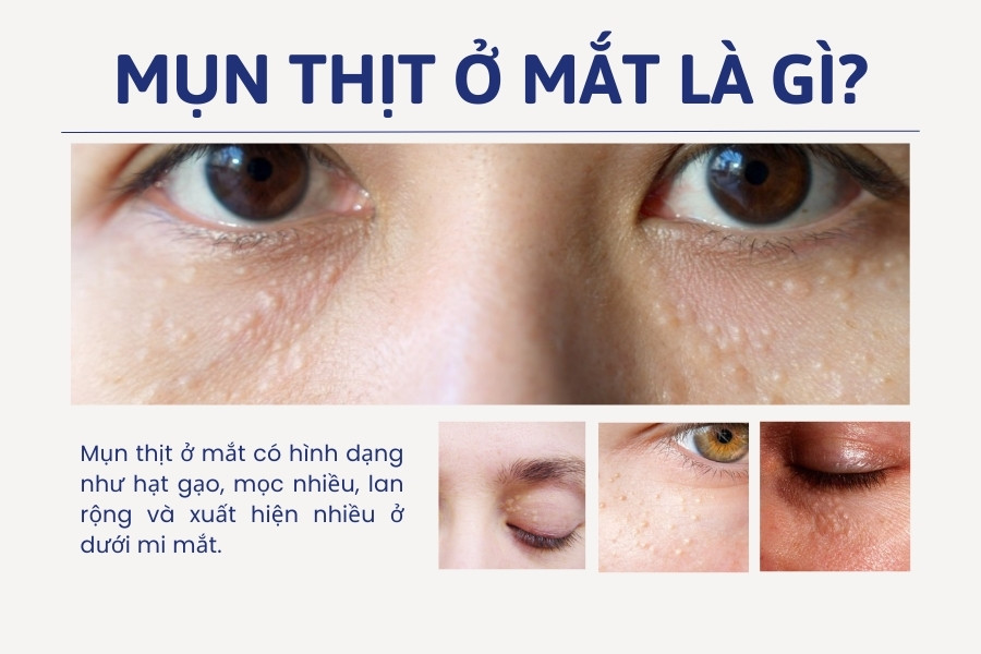 Mụn thịt quanh mắt là những khối ưu tuyến mồ hôi với kích thước li ti Mụn thịt quanh mắt là những khối ưu tuyến mồ hôi với kích thước li ti