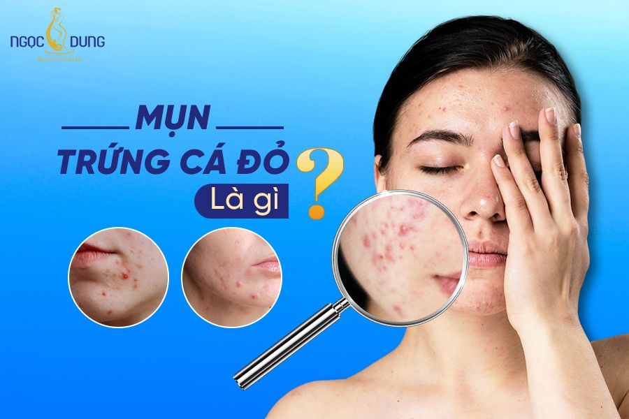 Mụn trứng cá đỏ là gì? Bật mí các cách điều trị mụn trứng cá đỏ hiệu quả