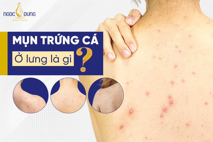 Mách ngay các cách trị mụn trứng cá ở lưng hiệu quả mà chị em không nên bỏ qua