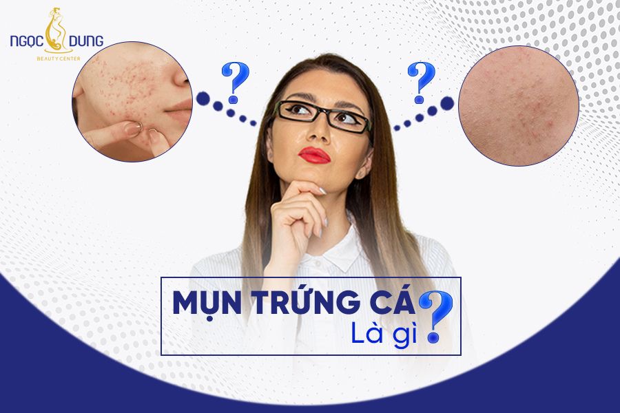 Mụn trứng cá là gì? Mụn trứng cá có nên nặn không? Giải đáp ngay cùng chuyên gia