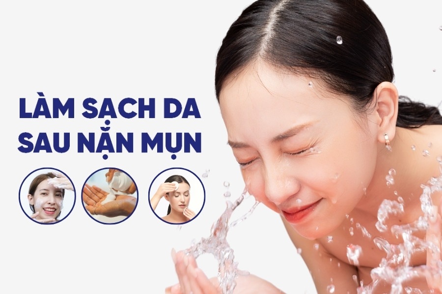 Nên làm sạch da bằng dung dịch sát khuẩn sau khi nặn mụn