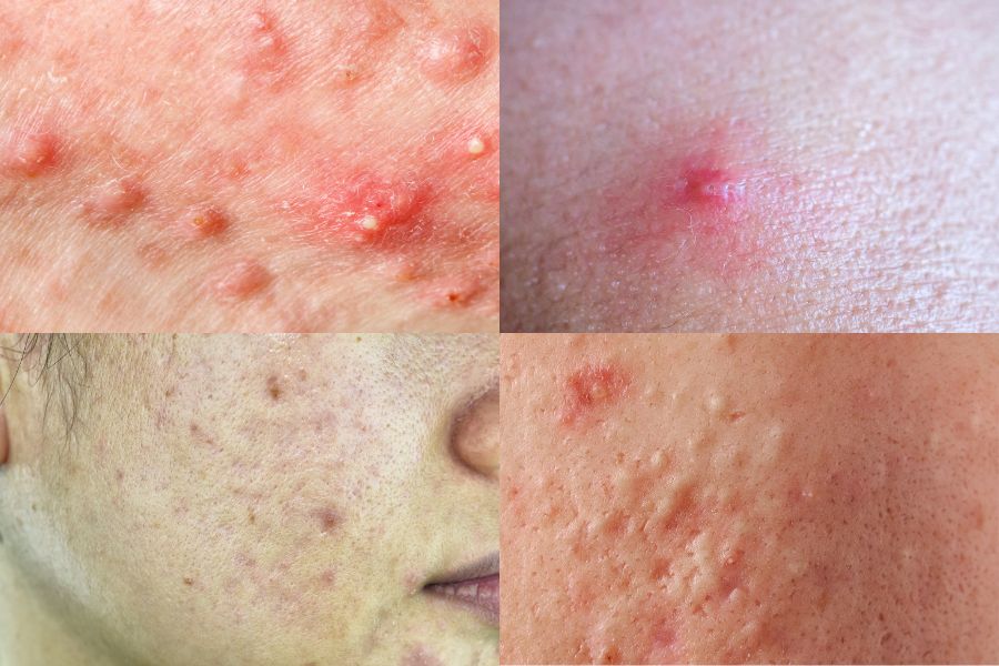 Các loại mụn thường xuất hiện phổ biến trên da mặt