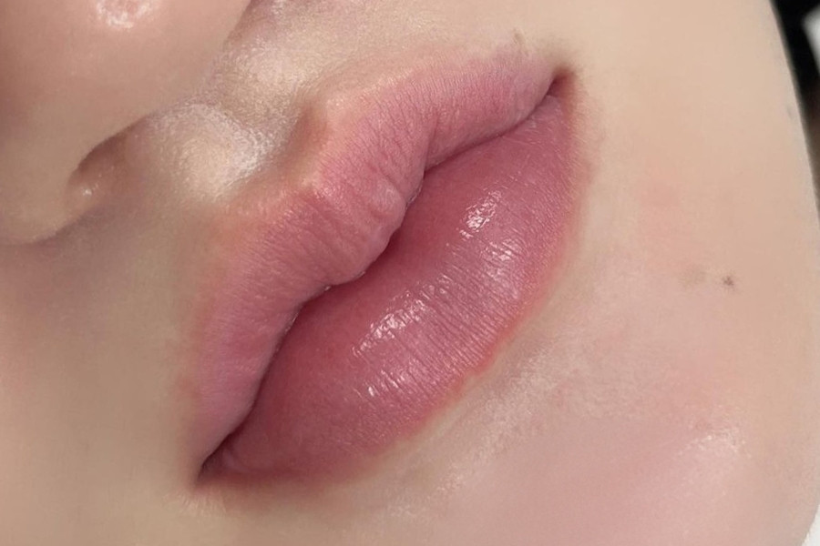 Môi thâm bẩm sinh chủ yếu do gen di truyền kết hợp với chăm sóc Môi thâm bẩm sinh chủ yếu do gen di truyền kết hợp với chăm sóc, cách trị môi thâm bẩm sinh chưa phù hợp