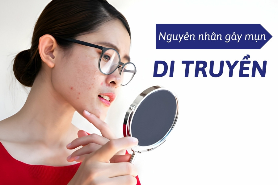 Di truyền cũng là một trong những nguyên nhân mọc mụn