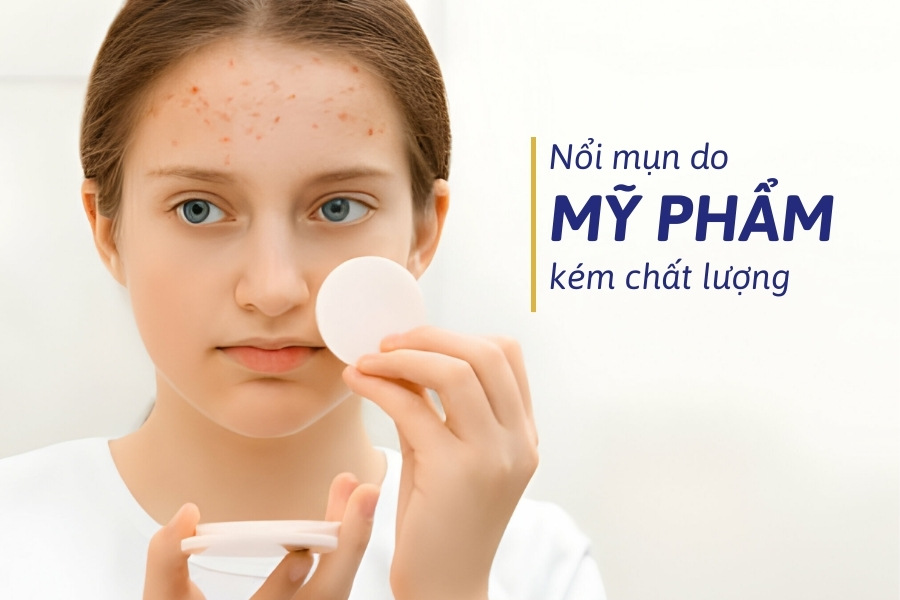 Mỹ phẩm kém chất lượng, không phù hợp cũng là nguyên nhân gây mụn