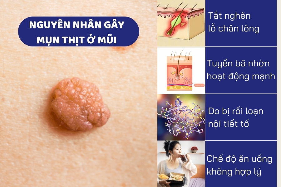 Rối loạn chuyển hóa dưới da là nguyên nhân chính gây ra mụn thịt Rối loạn chuyển hóa dưới da là nguyên nhân chính gây ra mụn thịt