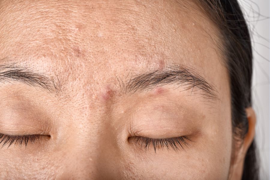 Giải đáp da mụn là gì và các loại mụn