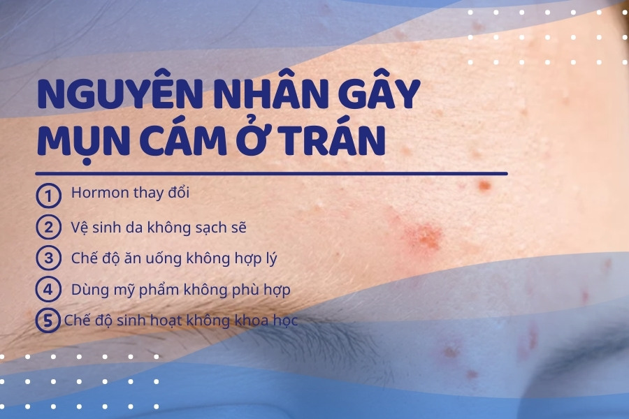 Mụn cám trên trán xuất hiện do nhiều nguyên nhân khác nhau Mụn cám trên trán xuất hiện do nhiều nguyên nhân khác nhau