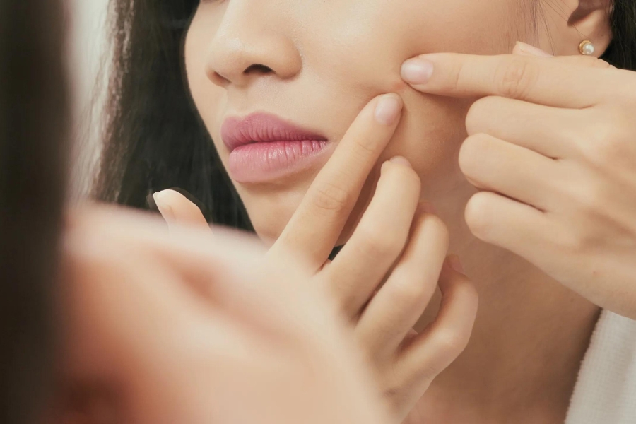 Lỗ chân lông to do không biết cách nặn mụn, tự nặn mụn