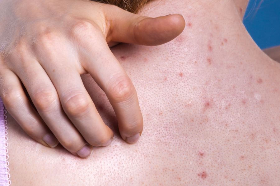 Không làm sạch cơ thể sau khi hoạt động ra nhiều mồ hôi là nguyên nhân hình thành mụn ở lưng Không làm sạch cơ thể sau khi hoạt động ra nhiều mồ hôi là nguyên nhân hình thành mụn ở lưng