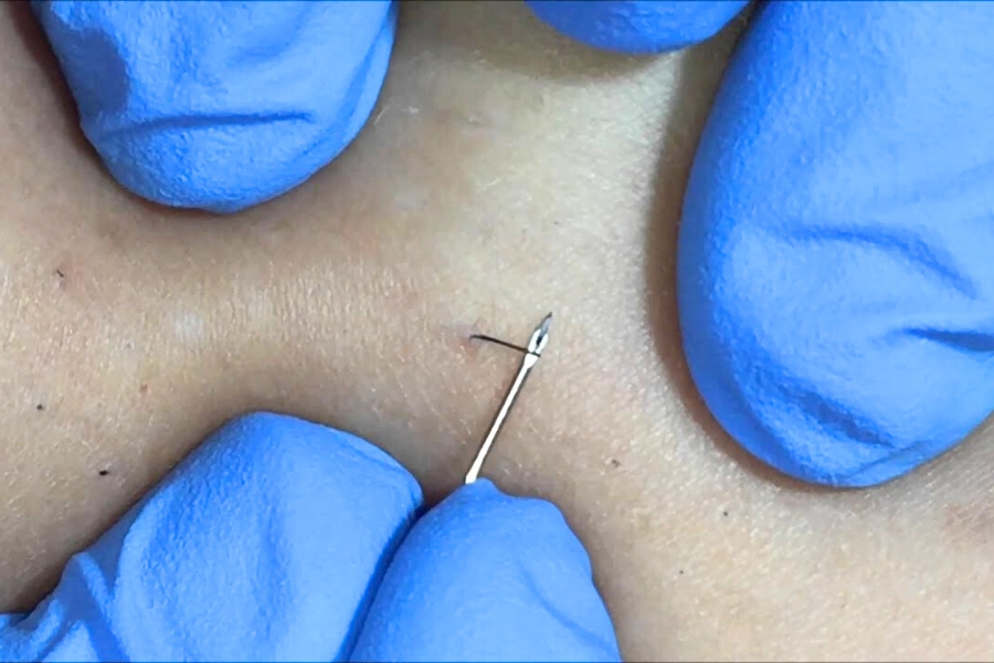 Dùng nhíp nhổ lông mọc ngược Dùng nhíp nhổ lông mọc ngược