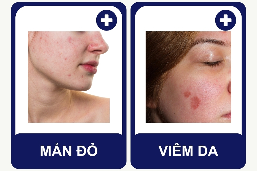 Tác dụng phụ khi dùng niacinamide là gì? Tác dụng phụ khi dùng niacinamide là gì?