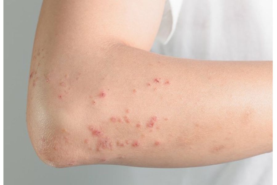 U hạt sinh mủ là tình trạng các nốt sưng nhỏ xuất hiện, chúng rất dễ chảy máu