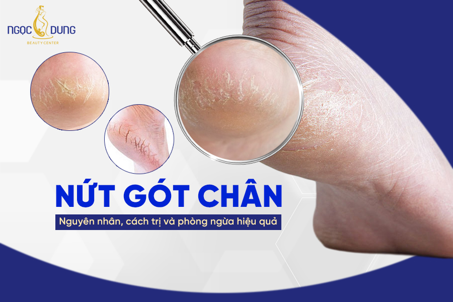 nứt gót chân