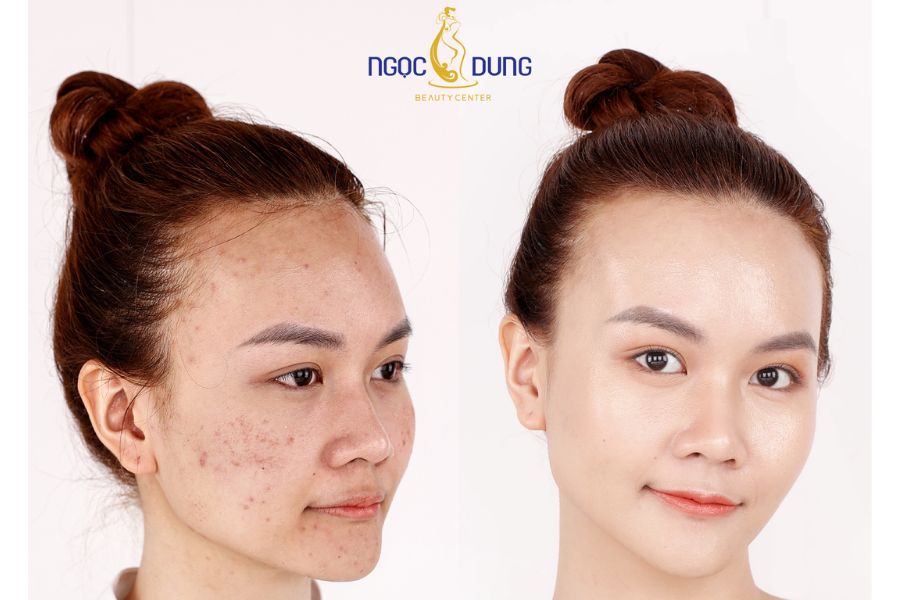 Hình ảnh khách hàng “lột xác” sau liệu trình điều trị mụn chuyên sâu tại Ngọc Dung beauty