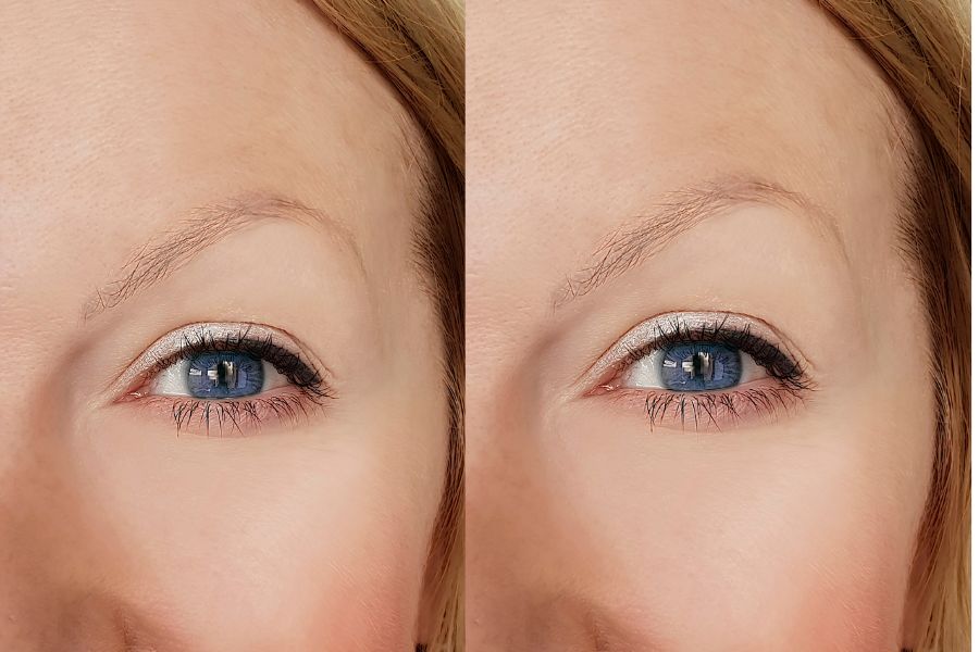 Thiếu hụt chất dinh dưỡng cũng là nguyên nhân khiến không có chân mày Thiếu hụt chất dinh dưỡng cũng là nguyên nhân khiến không có chân mày