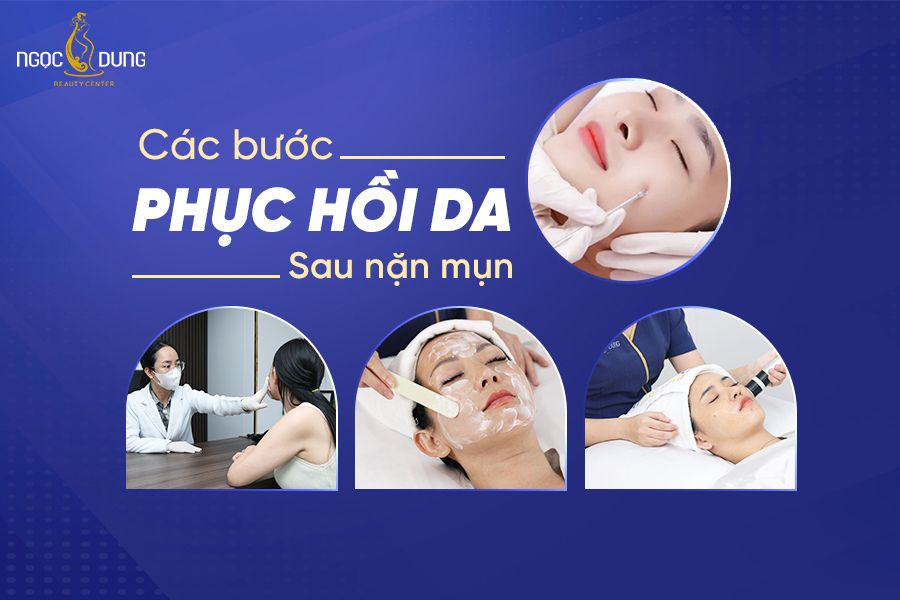 Mách chị em các bước phục hồi da sau mụn hiệu quả tại nhà