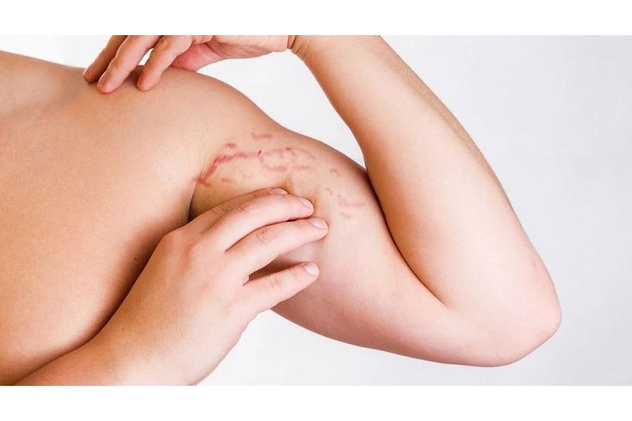 Rạn da đỏ do cơ bắp tăng trưởng quá mức