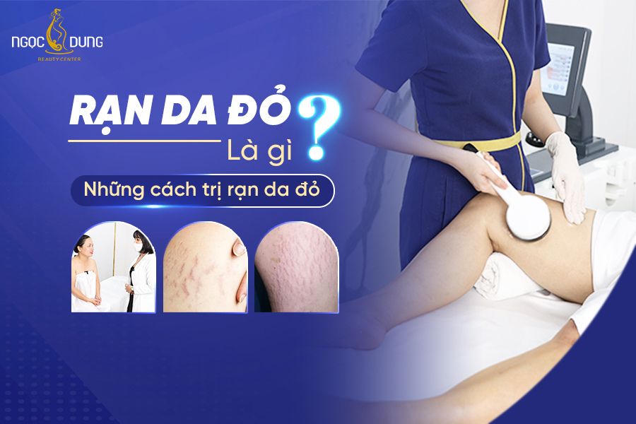 Rạn da đỏ có tự hết không? Hãy giải đáp ngay cùng chuyên gia
