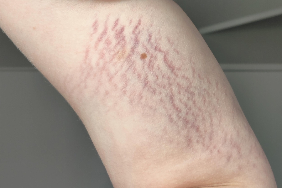 Rạn da vùng cánh tay trong giai đoạn dậy thì Rạn da vùng cánh tay trong giai đoạn dậy thì