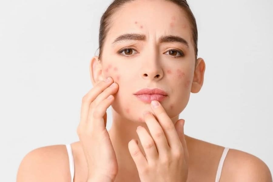 Bia chứa cồn nên có thể làm da dễ bị kích ứng và trở nên nhạy cảm hơn