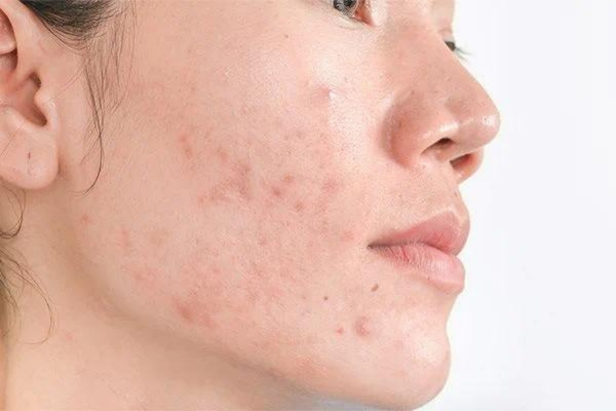 Hydroquinone là một chất làm trắng da, có hiệu quả sau 4 tuần