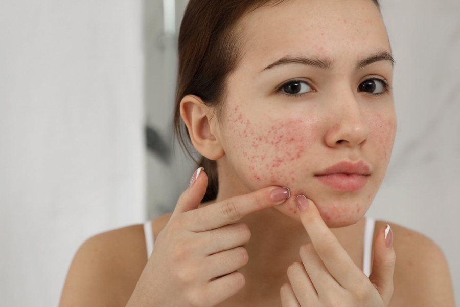 Kem chống nắng có thể làm mụn nổi nhiều hơn nếu sử dụng không đúng cách