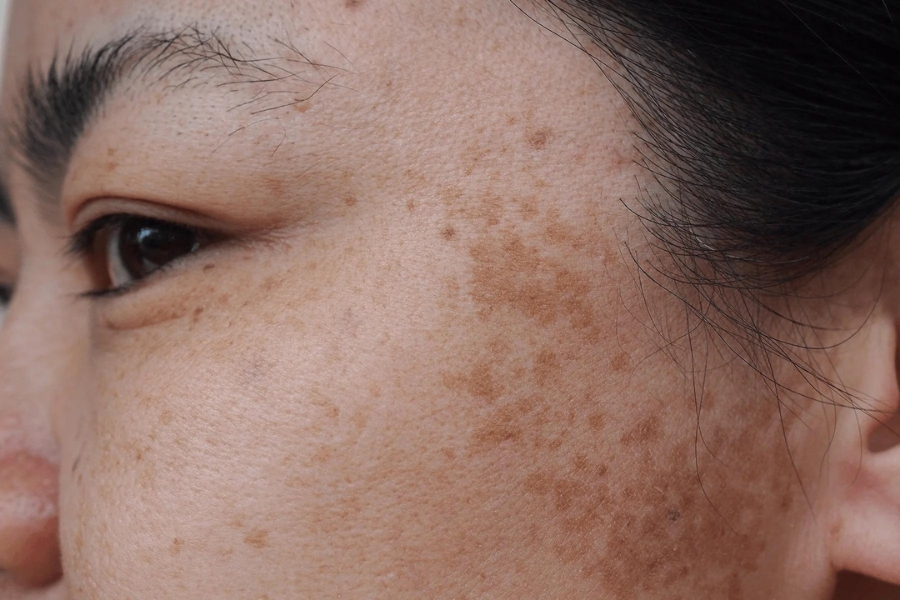 Hoạt chất niacinamide có tác dụng gì? Hoạt chất niacinamide có tác dụng gì?