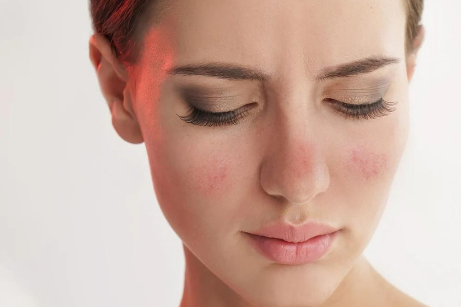 Tác hại của steroid liều lượng cao là có thể gây xuất huyết dưới da Tác hại của steroid liều lượng cao là có thể gây xuất huyết dưới da