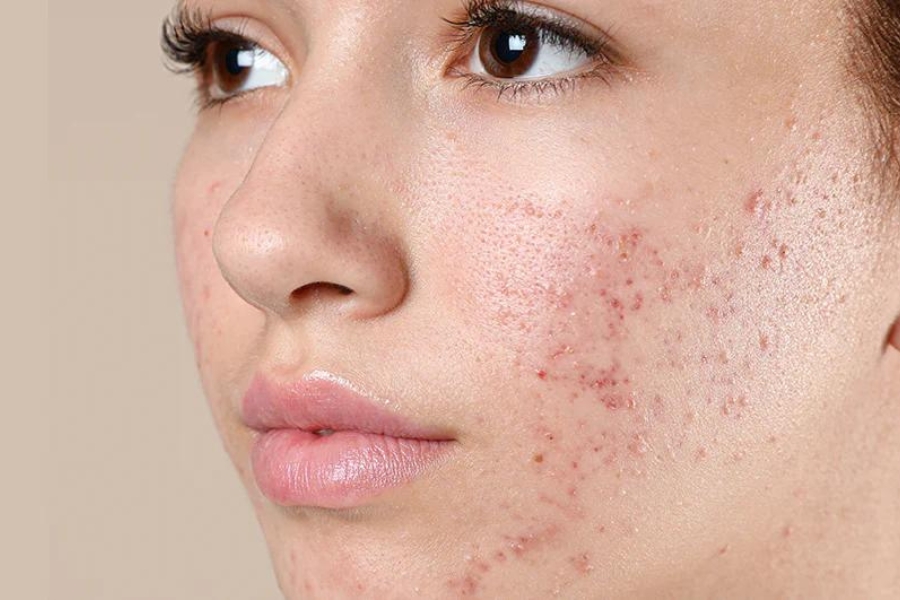 Tẩy trang bằng dầu dừa nếu không được làm sạch kỹ có thể gây nổi mụn