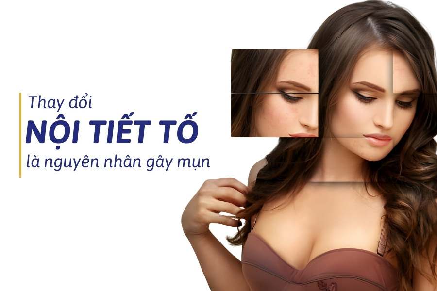 Nguyên nhân gây mụn do thay đổi nội tiết tố