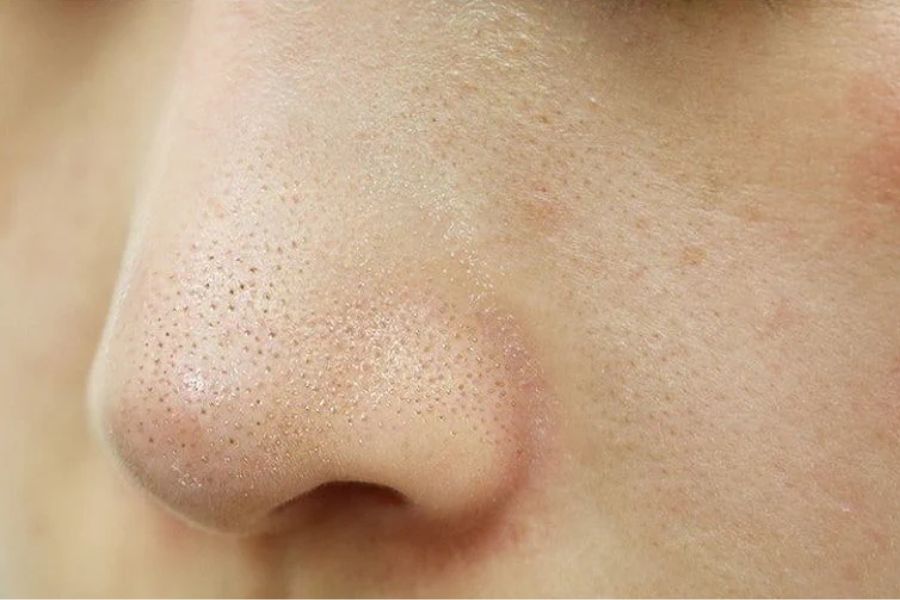 tri mun cam het bao nhieu tien 1