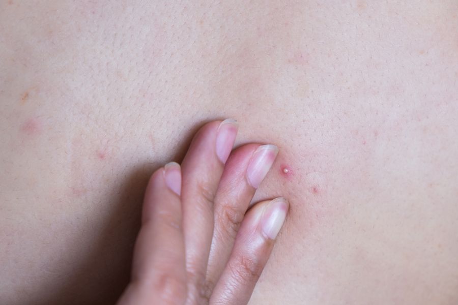 Giai đoạn hình thành mụn trứng cá ở lưng Giai đoạn hình thành mụn trứng cá ở lưng