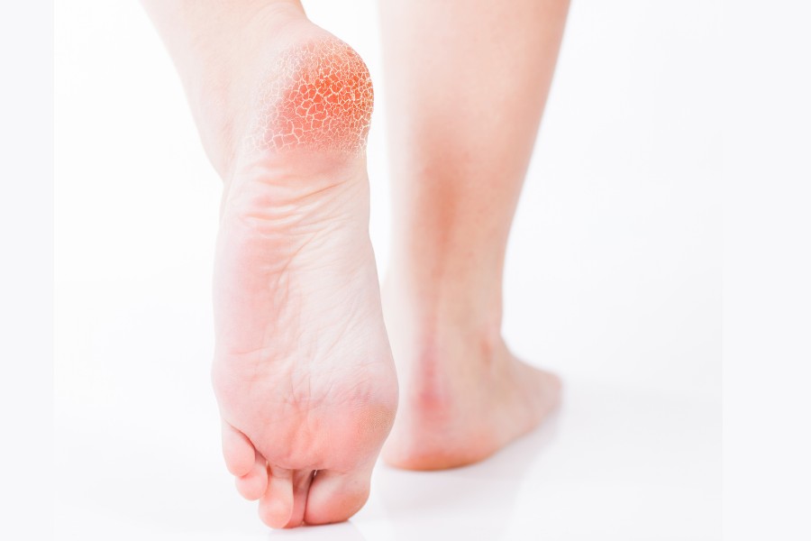 Da vùng gót chân hoặc bàn chân xuất hiện những vết nứt, rạn thô ráp gót chân khô nứt nẻ