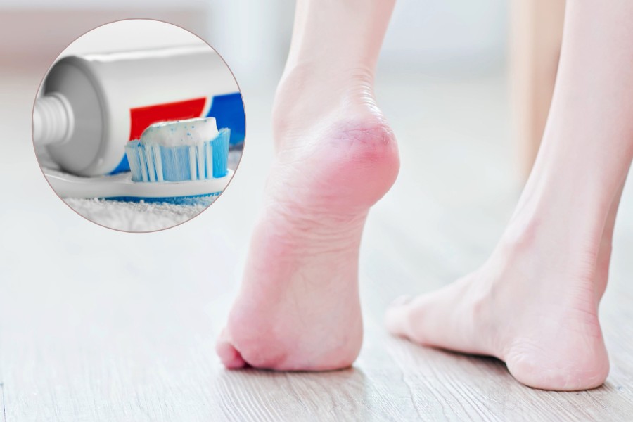 cách trị nứt gót chân bằng kem đánh răng