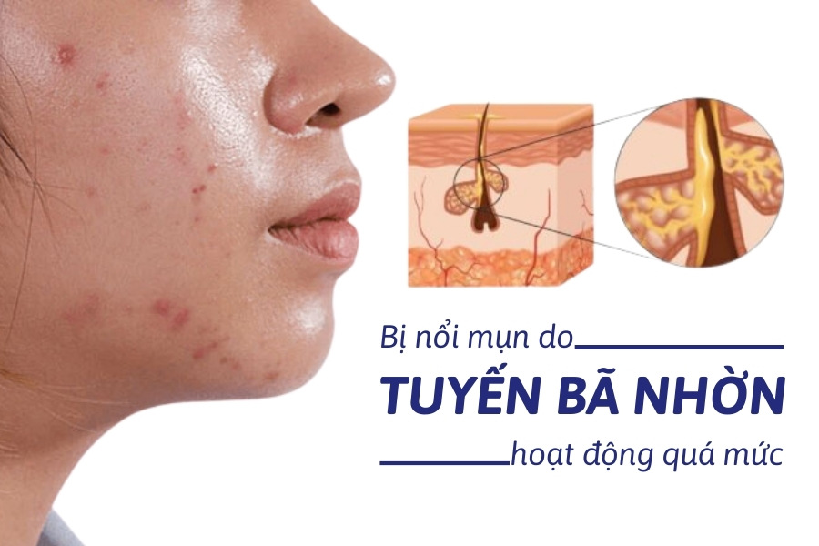 Dầu thừa quá nhiều cũng là nguyên nhân gây nổi mụn