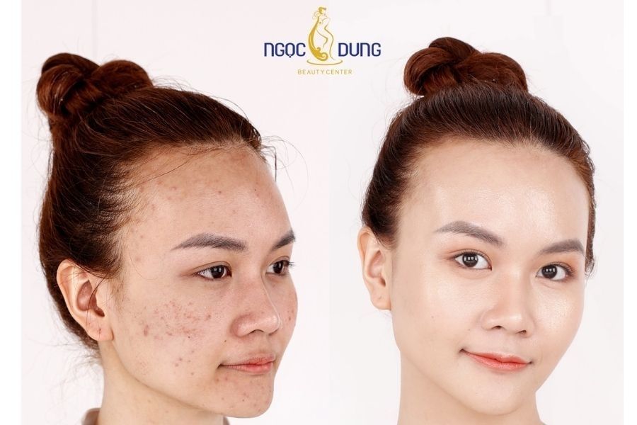 Hình ảnh khách hàng trước và sau khi điều trị mụn tại Ngọc Dung beauty